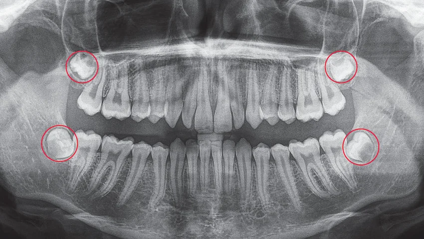 come posso lavarmi i denti dopo l'estrazione dei denti del giudizio