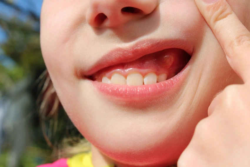 comment réduire votre risque d'hyperplasie gingivale