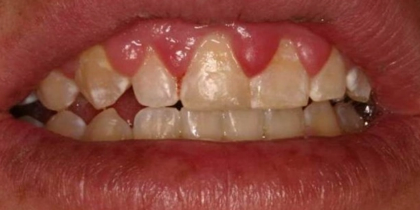 comment l'hyperplasie gingivale est-elle traitée