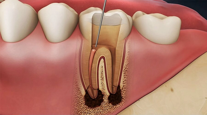 jak diagnozuje się pulpitis