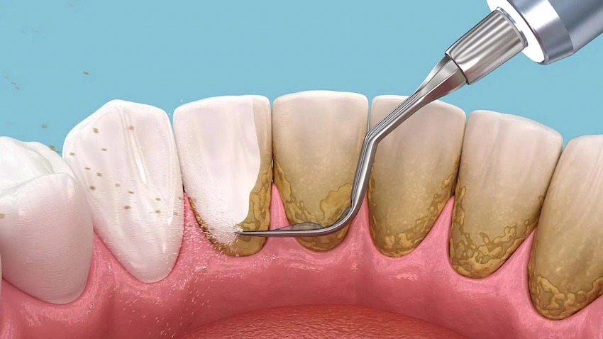 how to remove plaque