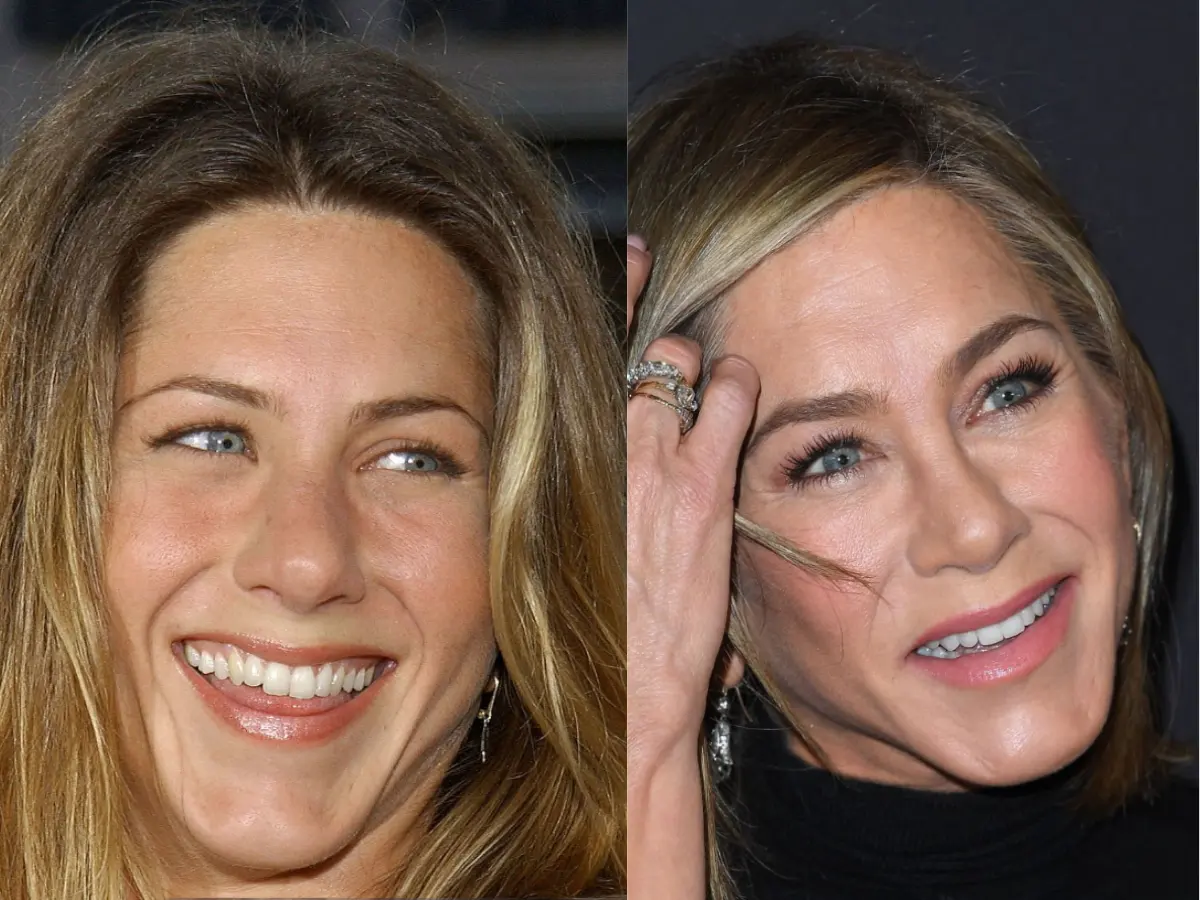 jennifer aniston teeth before and after