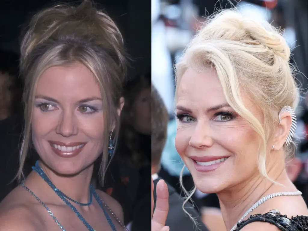 katherine kelly teeth before and after
