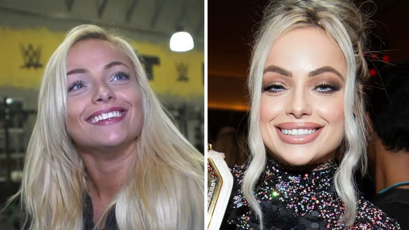 liv morgan teeth before after