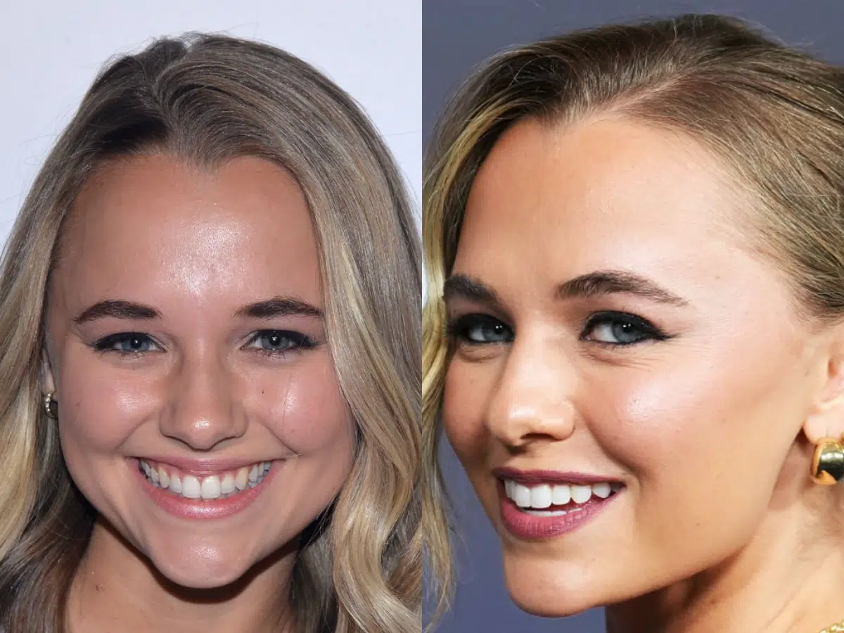 madison iseman teeth before after