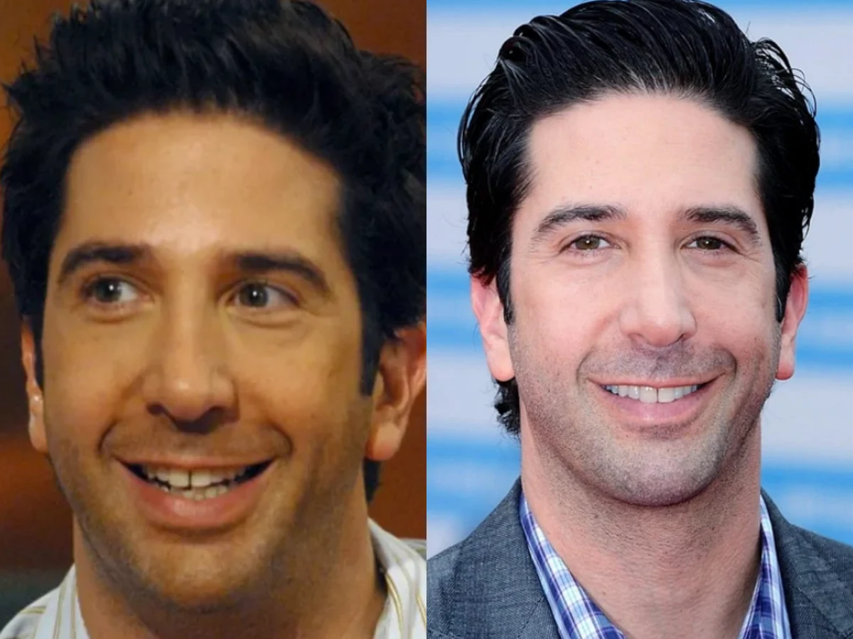 ross geller teeth before after