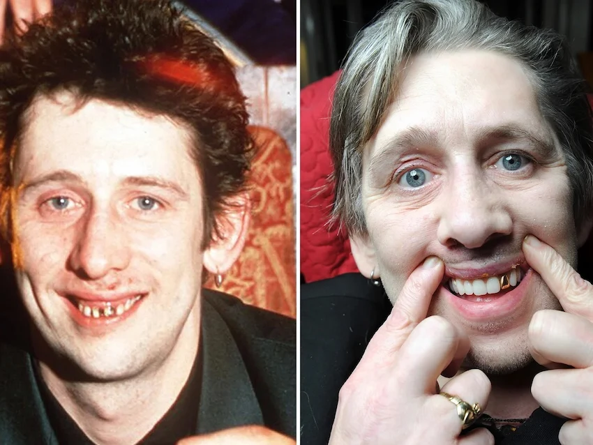 shane macgowan teeth before after