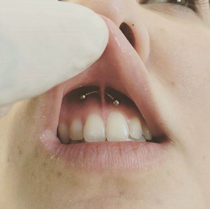 puncție smiley
