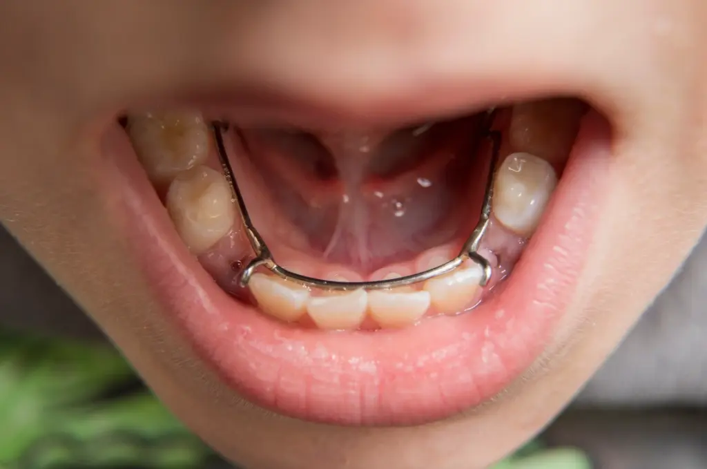 spacer for teeth