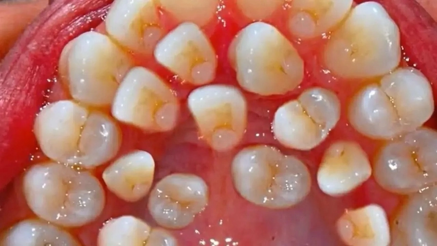 supernumerary teeth