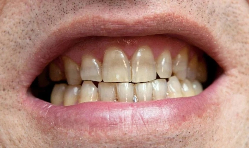 tetracycline teeth treatment