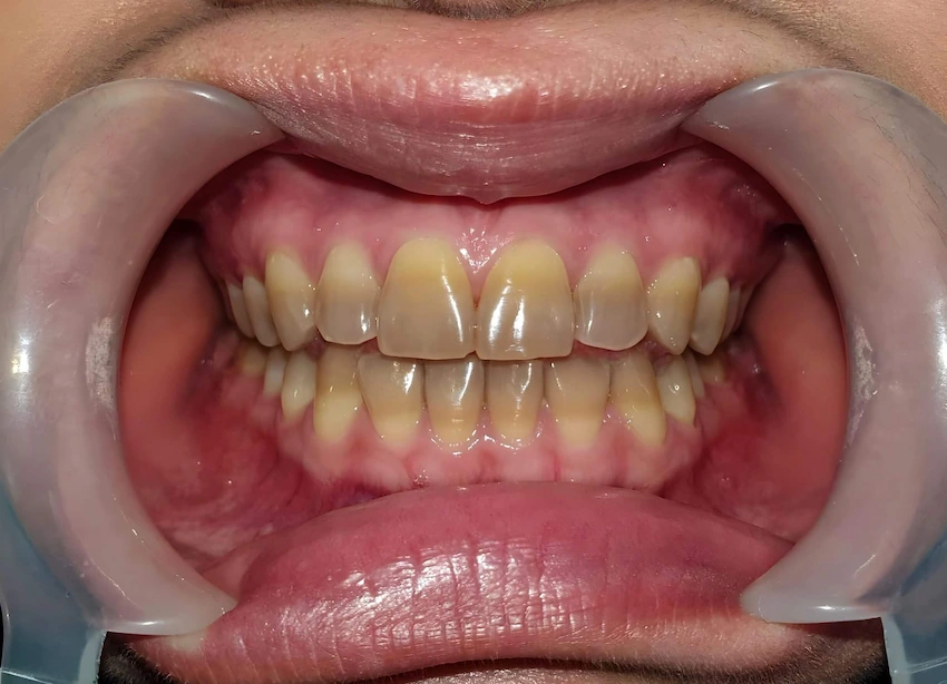 tetracycline teeth