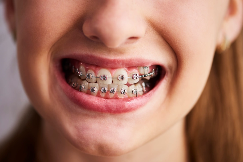 what are the types of braces