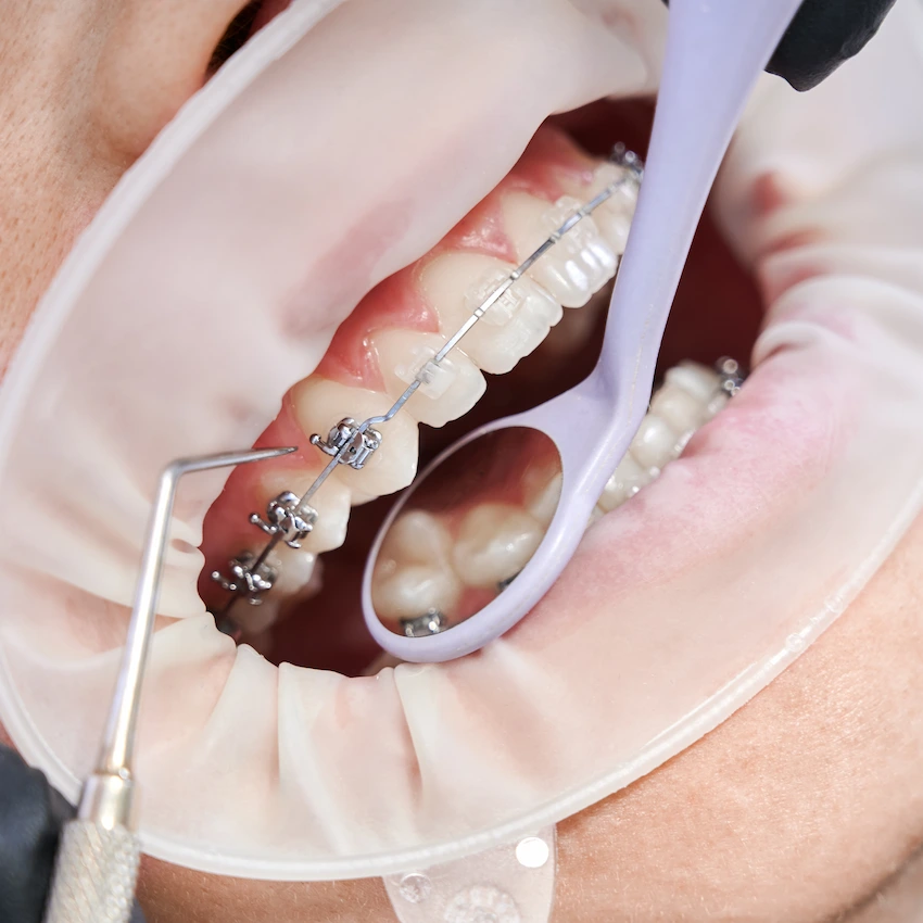 qué causa el colapso dental
