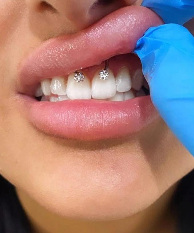 ce este o puncție smiley
