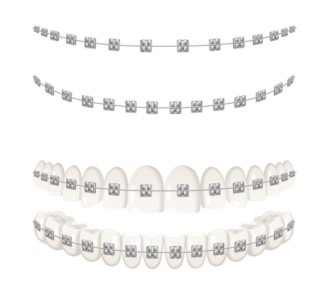 orthodontics en retainer