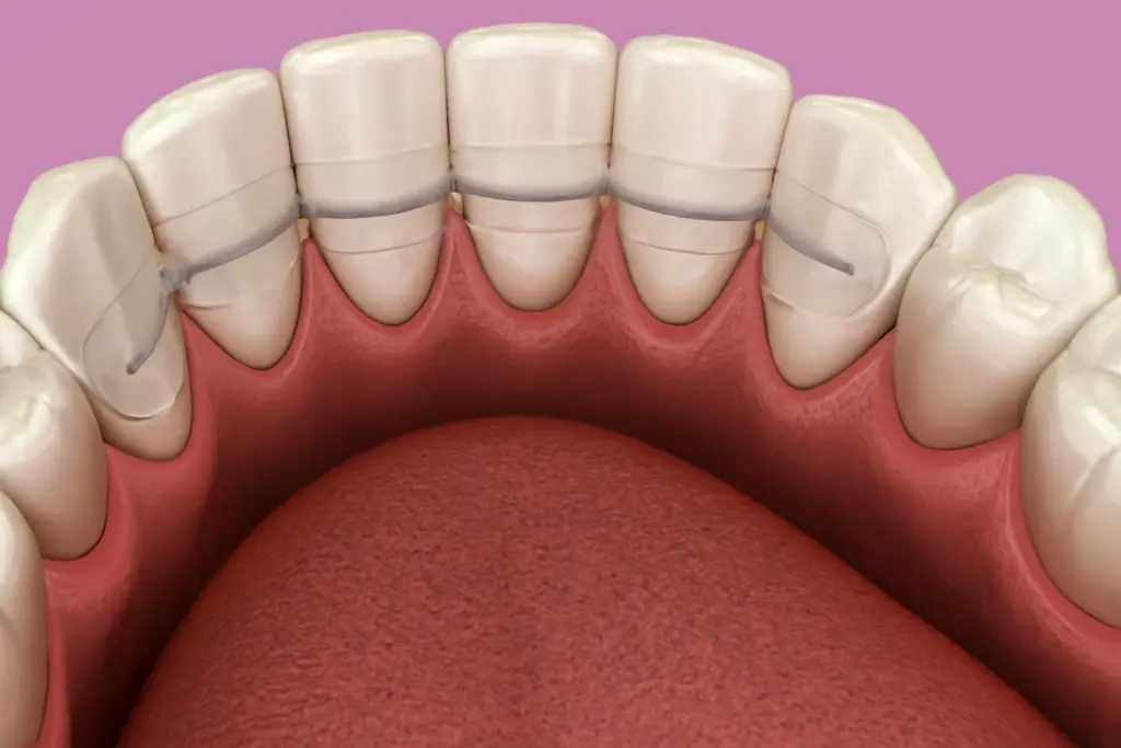 hoe je je retainer schoonmaakt