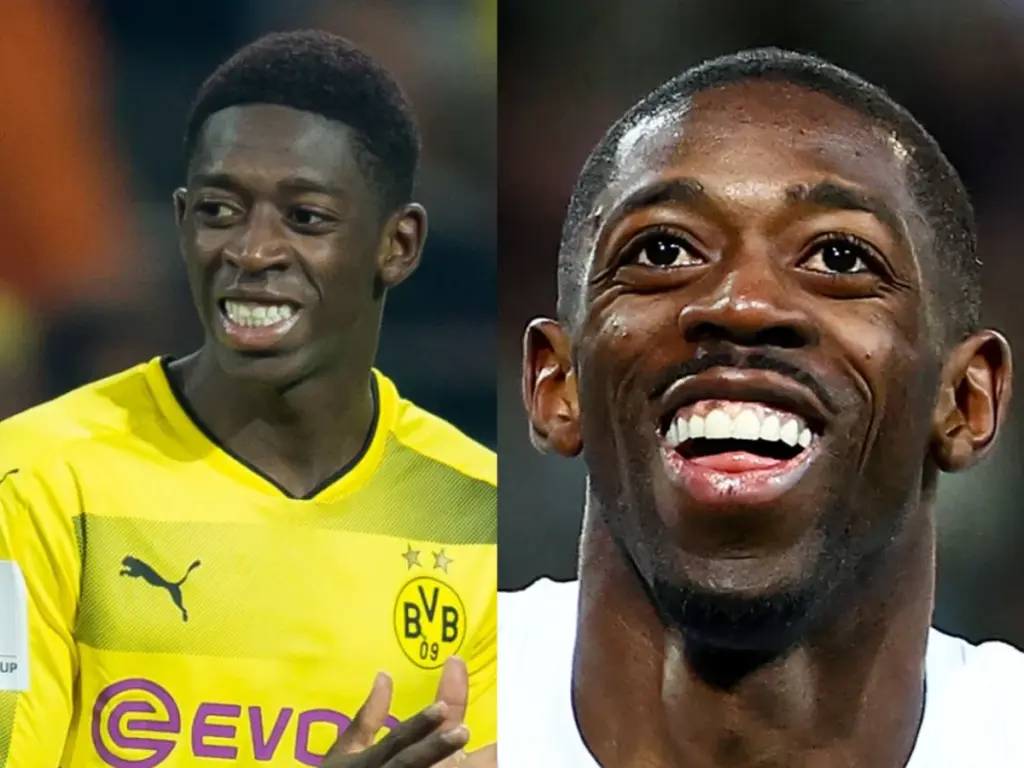 ousmane dembélé teeth before after