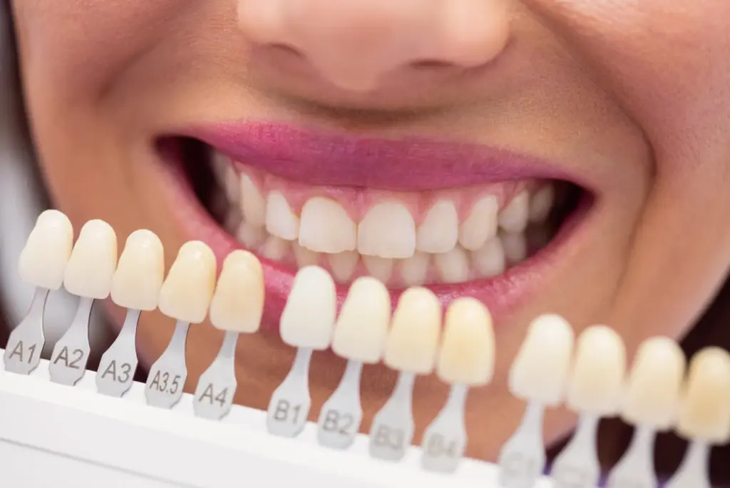veneers-kosm-hambaravi