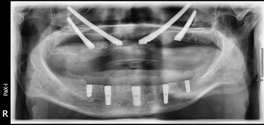 İstanbul’da zigomatik implantlar