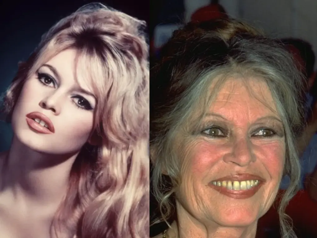 brigitte-bardot-teeth-before-after