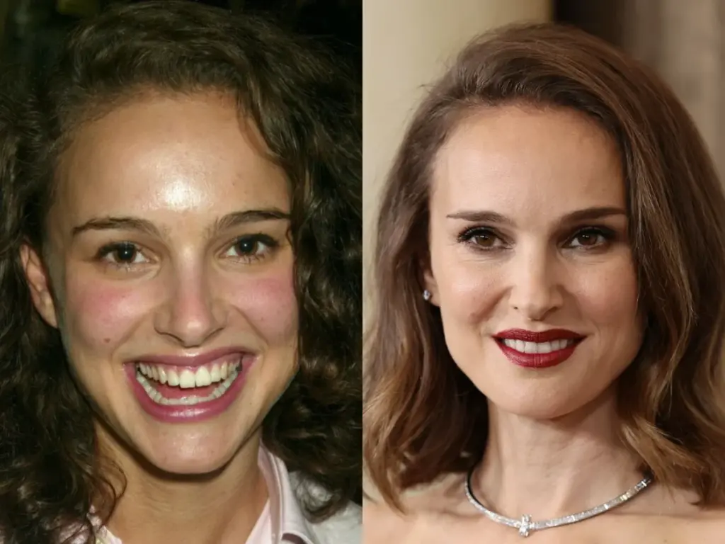 нтелли портман зубы до и после