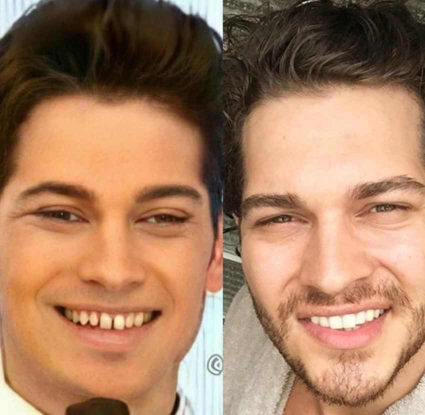 cagatay ulusoy teeth 2010
