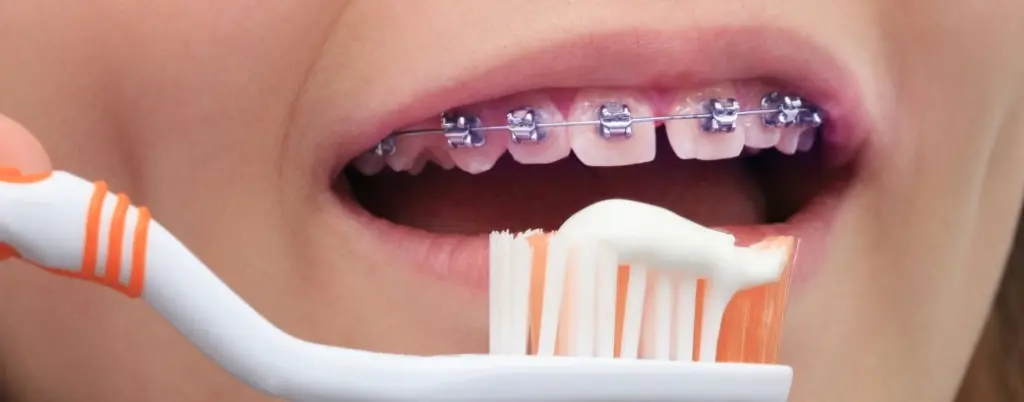 تقويم الأسنان للمراهقين