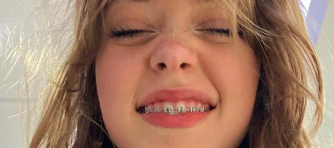 تقويم الأسنان للمراهقين