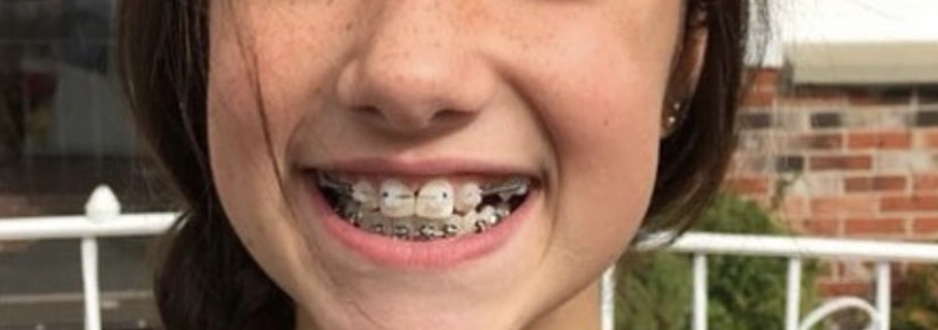 dental-braces-for-teens