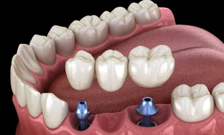 dental-implant-surgery