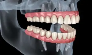 dental-implant