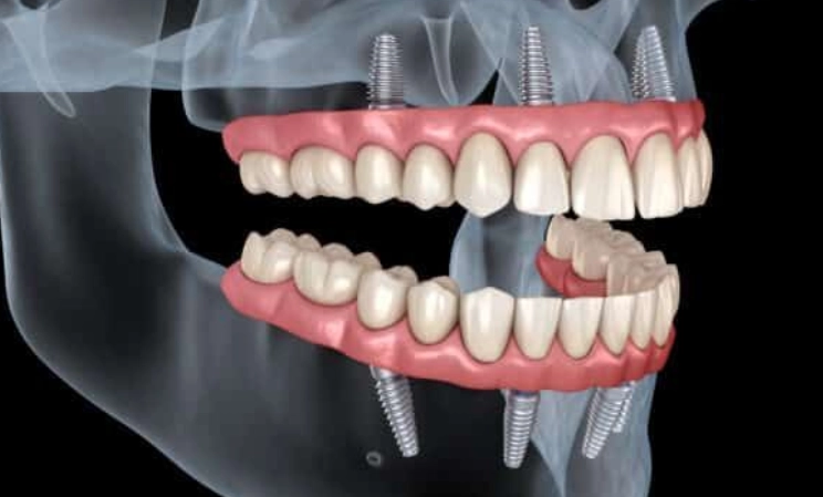 οδοντικό εμφύτευμα