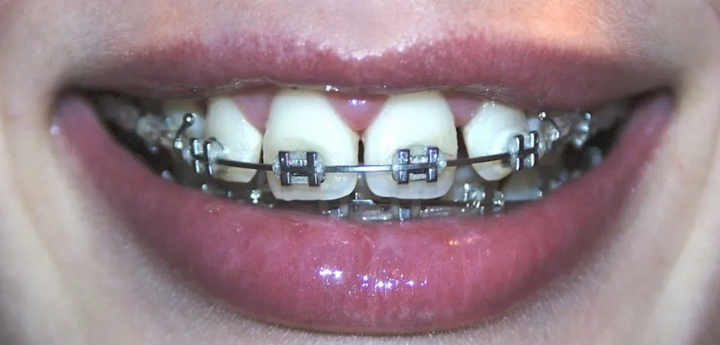 cera-dental-para-brackets