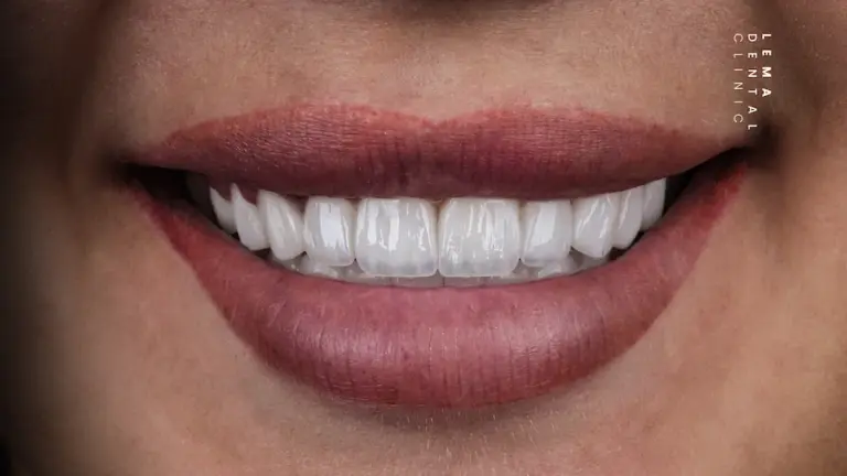 hollywood smile after photo lema dental clinic 1