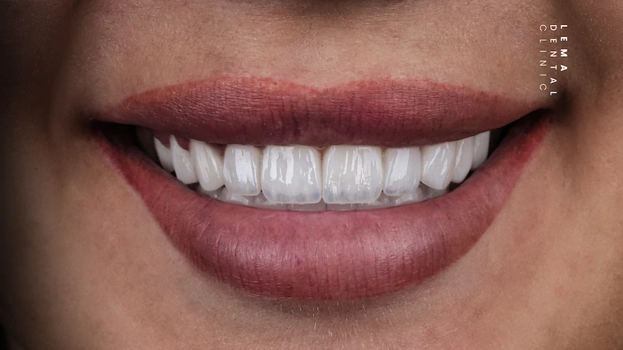 hollywood smile after photo lema dental clinic 1