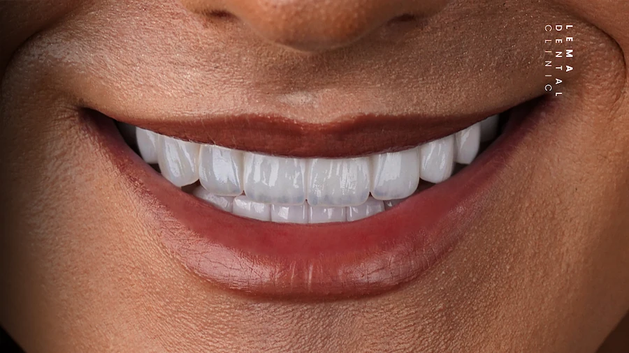 hollywood smile after photo lema dental clinic 2