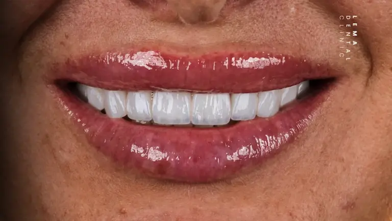 dental implants turkey: hollywood smile after photo lema dental clinic