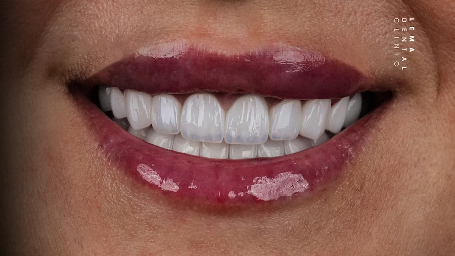 hollywood smile after photo lema dental clinic 4
