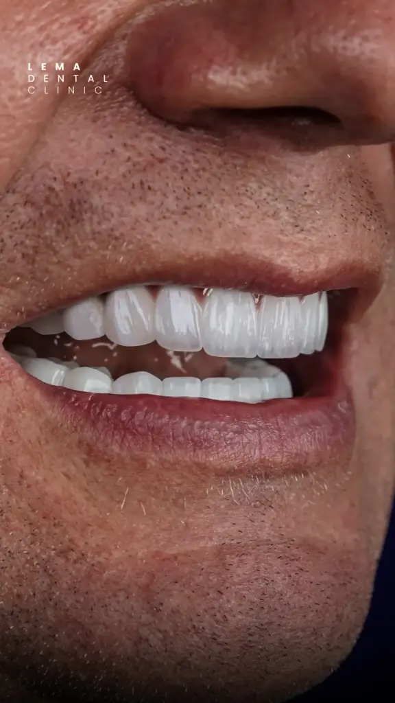 hollywood smile after photo lema dental clinic 5
