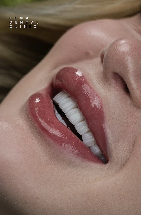 full-mouth-implant-surgery-at-lema-clinic