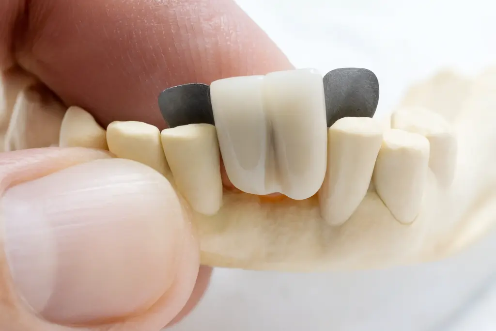 quanto dura un ponte dentale Maryland