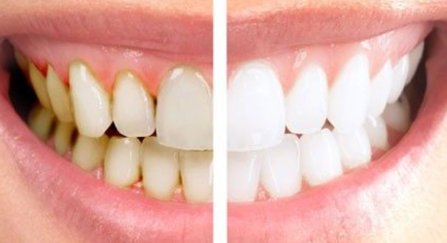 teeth-scaling