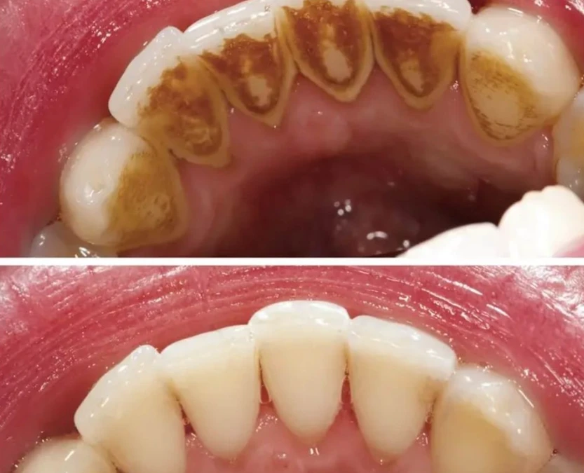 teeth-scaling