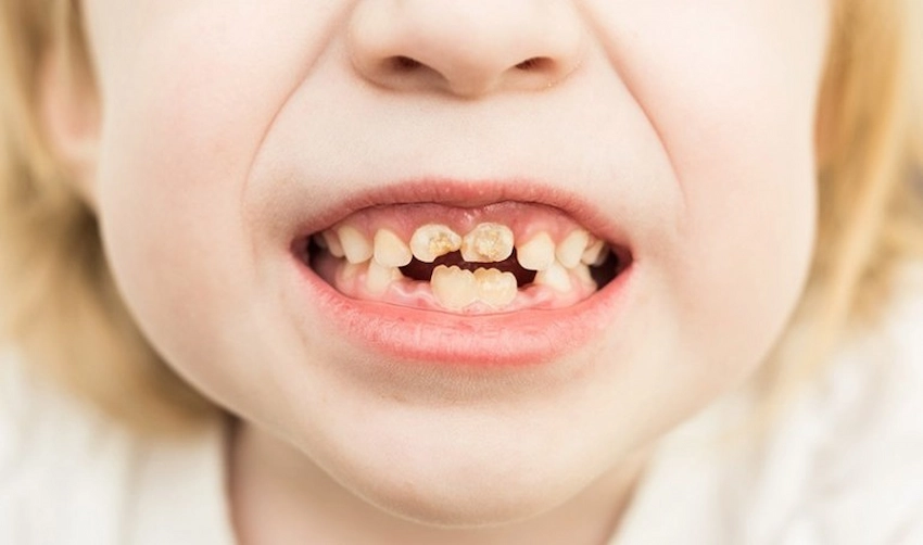 vad orsakar tandfärgning