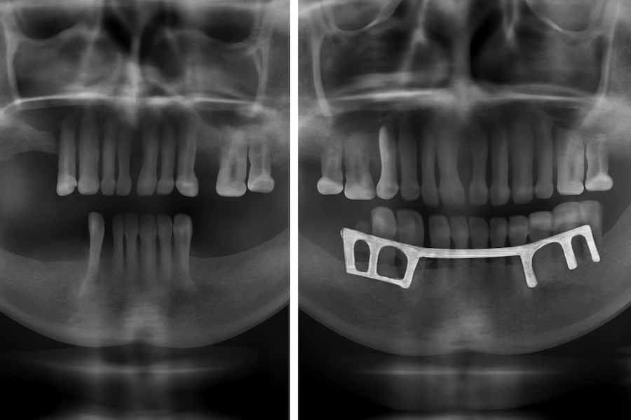 Röntgen Endosteal ve Subperiostal implantler