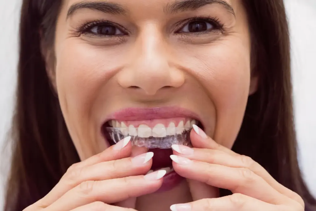 invisalign-dental-code