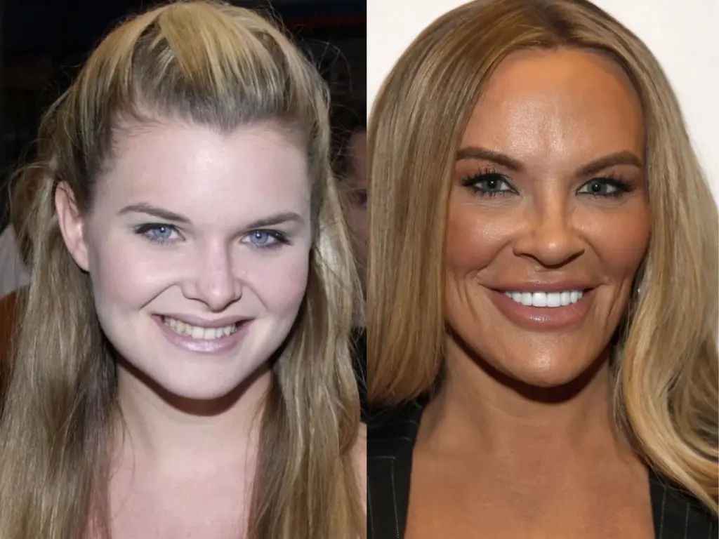 heather gay teeth before after