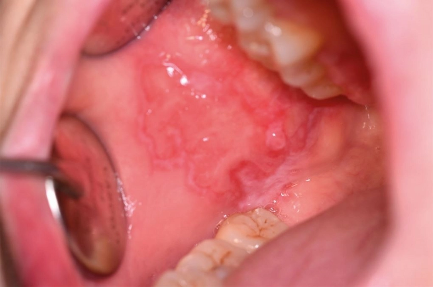 cancro della mucosa orale