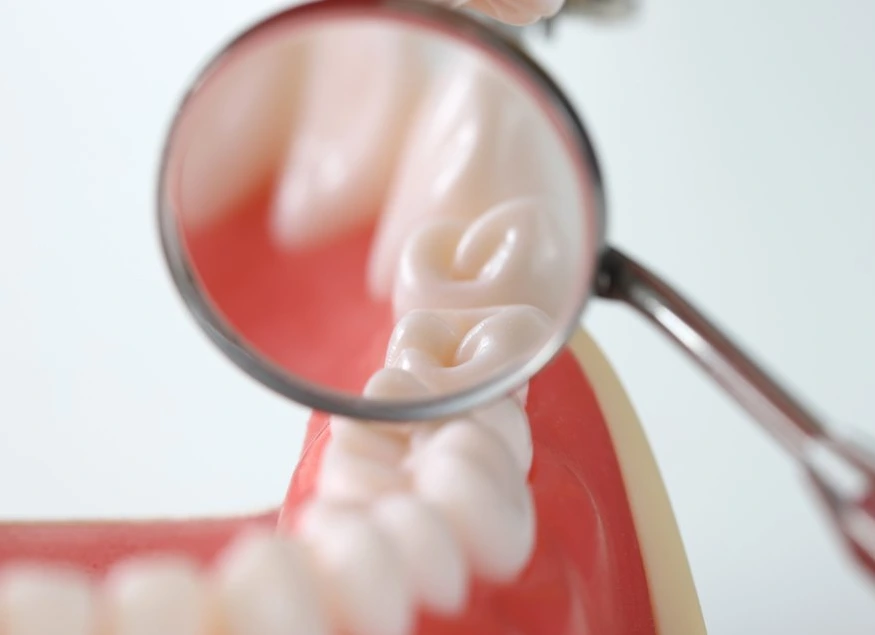 reparasjon av tannemalje